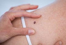 Saiba mais sobre o câncer de pele